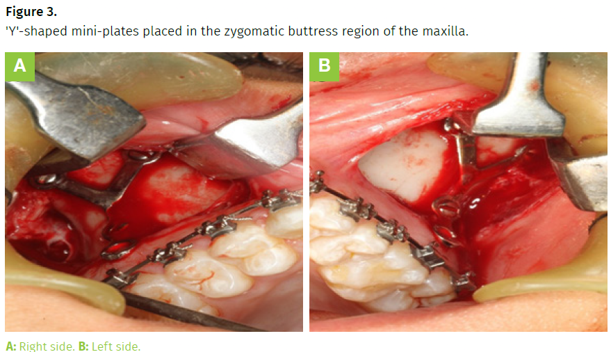 region maxilla 