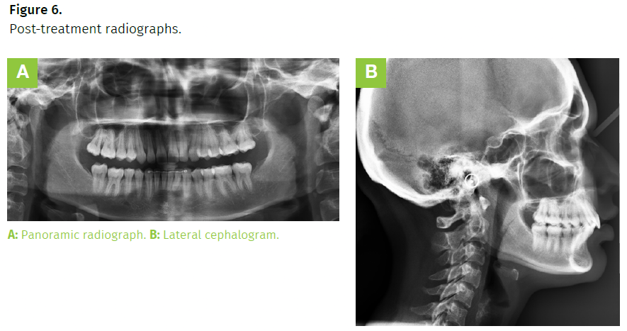 occlusal inter