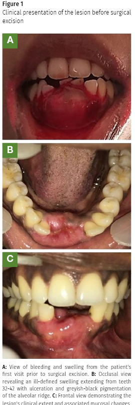 supernumerary tooth