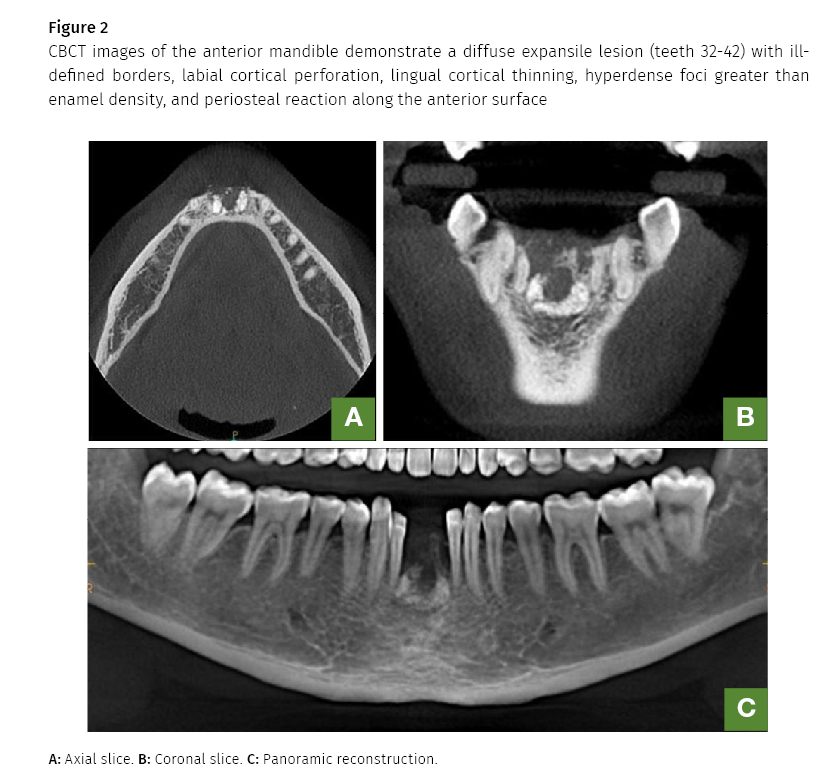 supernumerary tooth